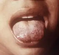 A child presenting a "scorbutic tongue" due to vitamin C deficiency.