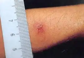 Scrub typhus eschar