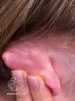 Seborrhoeic dermatitis ear