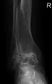 Frontal X-ray scan of ankle with secondary osteoarthritis