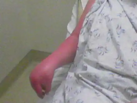 Severe CRPS of right arm