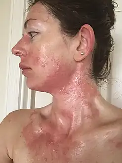 Severe allergic reaction to urushiol (poison oak) 4 days after exposure.