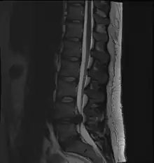 A rather severe herniation of the L4–L5 disc