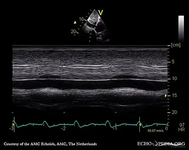 Echocardiogram: severe TR