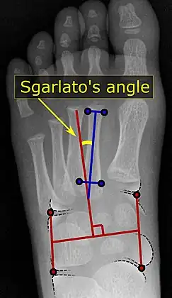 A Sgarlato's angle of more than 15° indicates pigeon toe.