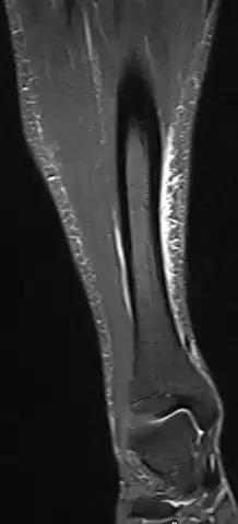 Magnetic resonance image of the lower leg in the coronal plane showing high signal (bright) areas around the tibia as signs of shin splints.