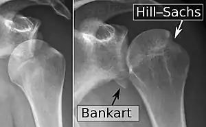 X-ray at left shows anterior dislocation in a young man after trying to get up from his bed. X-ray at right shows same shoulder after reduction and internal rotation, revealing both a bony Bankart lesion and a Hill-Sachs lesion.