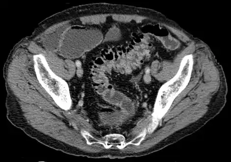 CT scan showing extensive diverticulosis of the sigmoid colon