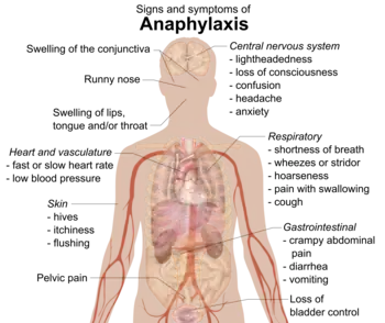 Signs and symptoms of anaphylaxis