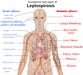 A schematic of the human body showing the symptoms and signs of leptospirosis