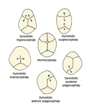 Trigonocephaly as a kind of craniosynostosis