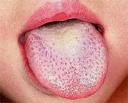White coating on tongue: white strawberry tongue