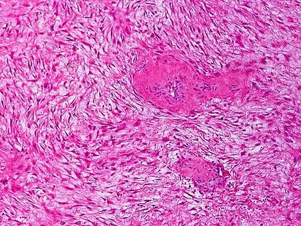 Desmoid fibromatosis, H&E stain. Banal fibroblasts infiltrate the adjacent tissue in fascicles. Mitoses may be infrequent.