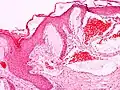 Scrotal angiokeratoma (Fordyce type); dilated cavernous capillaries, acanthosis