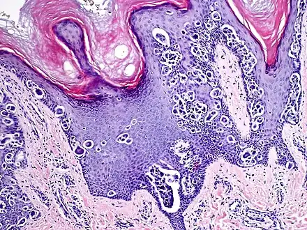 Melanocytic acral nevus with intraepidermal ascent cells (MANIAC)