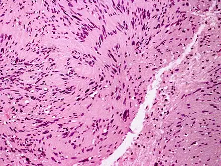 Skin tumors(palisaded encapsulated neuroma)
