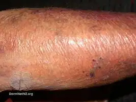 Skin thinning due to topical steroids