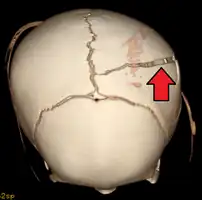 3D CT reconstruction showing a skull fracture in an infant
