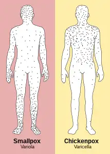 In contrast to the rash in smallpox, the rash in chickenpox occurs mostly on the torso, spreading less to the limbs.