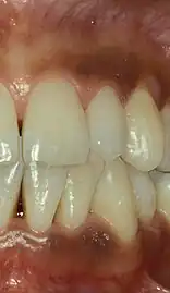 Smoker's melanosis in upper and lower gums.