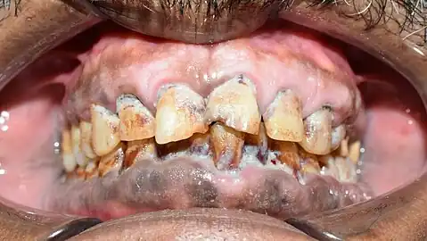 Smoker melanosis in a individual consuming 2 packs of cigarette per day