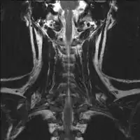 2.b. MRI neck (view from behind): solitary plasmacytoma C6