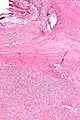 Solitary fibrous tumor - low magnification. H&E stain.