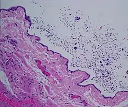 Dilated rete testis containing spermatozoa within cyst lumen. H&E stain 20x