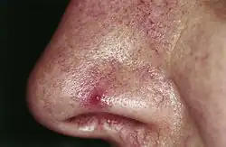 Nevus araneus (spider nevus): in the center of the red lesion a small (1 mm) red papule is visible, surrounded by several distinct radiating vessels. Pressure on the lesion causes it to disappear, however blanching is replaced by rapid refill from the central arteriole when pressure is released.