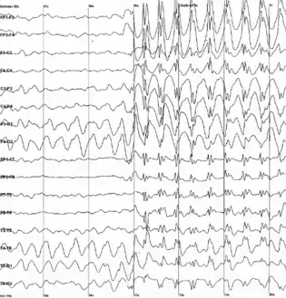Epileptic spike and wave discharges monitored with EEG