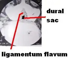 CT scan of spinal stenosis and thickened ligamentum flavum, causing neurogenic claudication