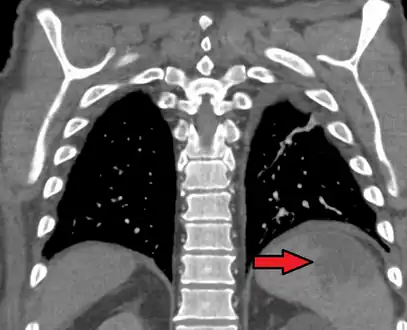 Splenic infarct seen on CT