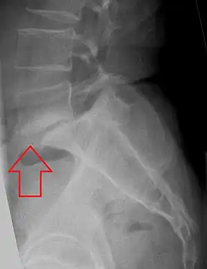 L5 S1 Spondylolisthesis Grade II with forward slipping of L5 on S1 <50%