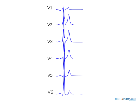 Precordial leads of a 12-lead ECG from a person with short QT syndrome