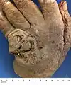 Squamous carcinoma of dorsum of hand