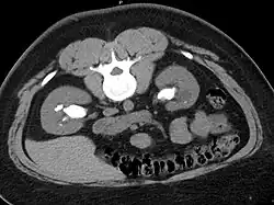 Bilateral staghorn calculi as seen on CT