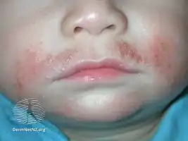 Staphylococcal infection of atopic dermatitis