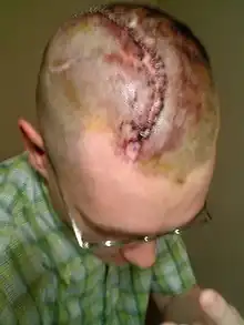 Man with a scar remained on his scalp from cranioplasty