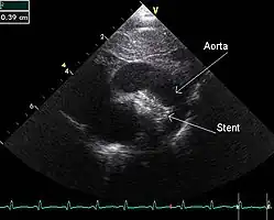 An echocardiogram of a stented persisting ductus arteriosus: One can see the aortic arch and the stent leaving. The pulmonary artery is not seen.