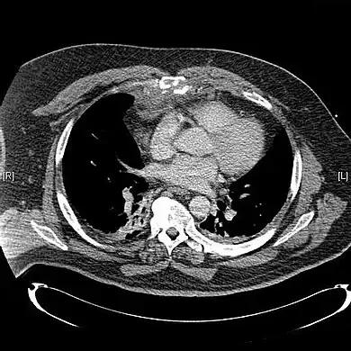 CT scan showing a comminuted sternal fracture.