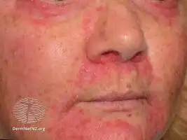 Steroid rosacea