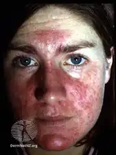 Steroid rosacea