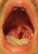 Mouth wide open showing the throatA throat infection which on culture tested positive for group A streptococcus. Note the large tonsils with white exudate.
