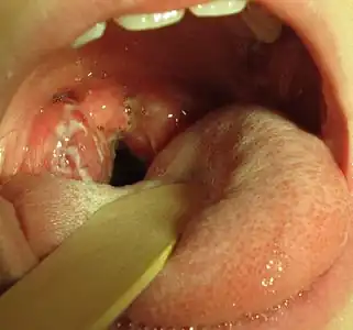 Strep throat with large tonsils covered in exudate