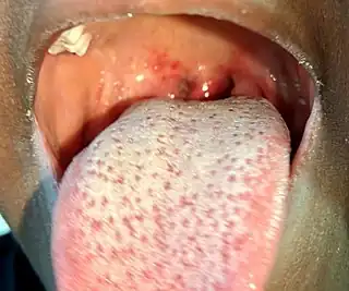 Strep throat with spots on soft palate, red uvula and strawberry tongue
