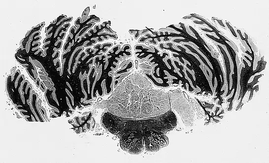 Subependymomas of the fourth ventricle, extending into the cerebellopontine angle via the foramen of Luschka, right side of illustration.