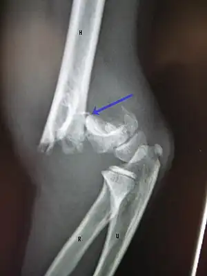 A displaced supracondylar fracture in a child