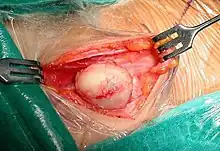 Surgery of a suprasternal epidermoid cyst, showing a smooth surface