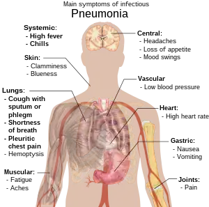 A diagram of the human body outlining the key symptoms of pneumonia