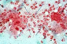 Trichomonas vaginalis Gram stain (arrows)